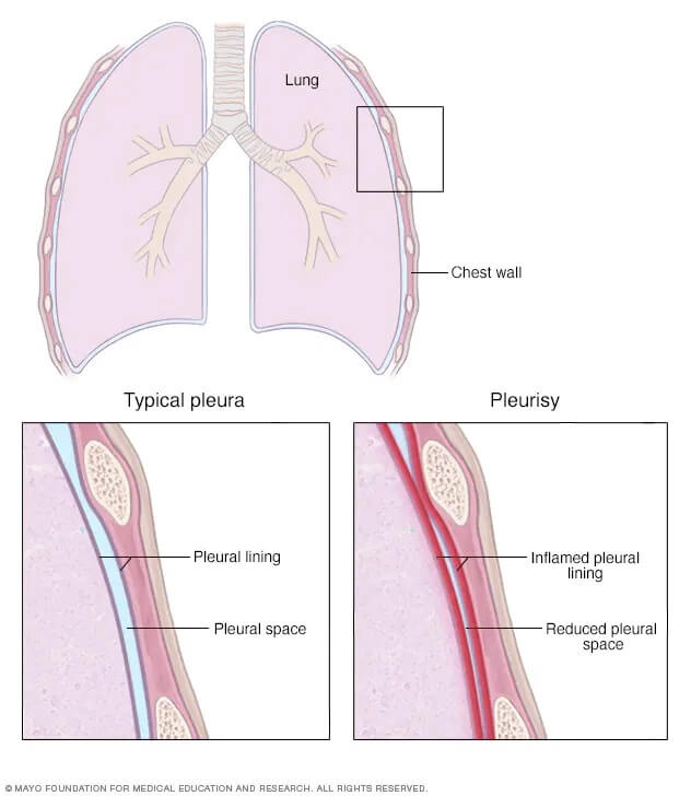 lungs Pleurisy 