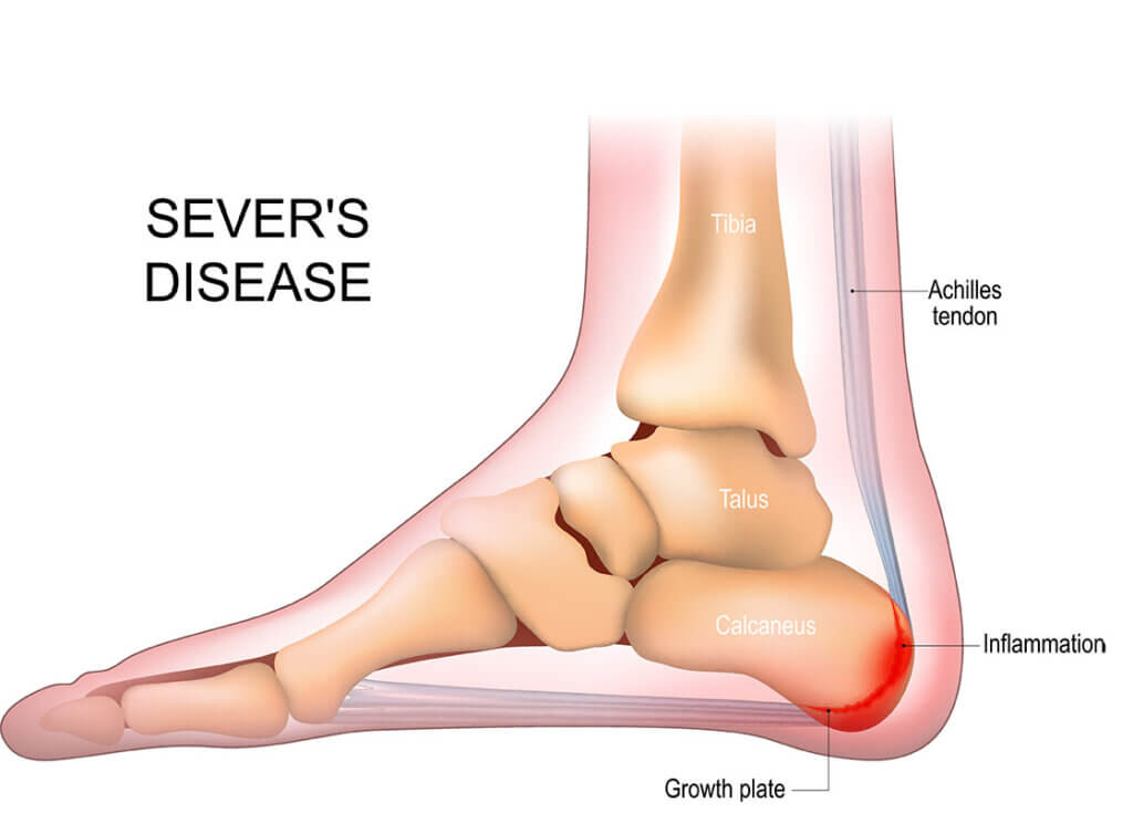 sever's disease