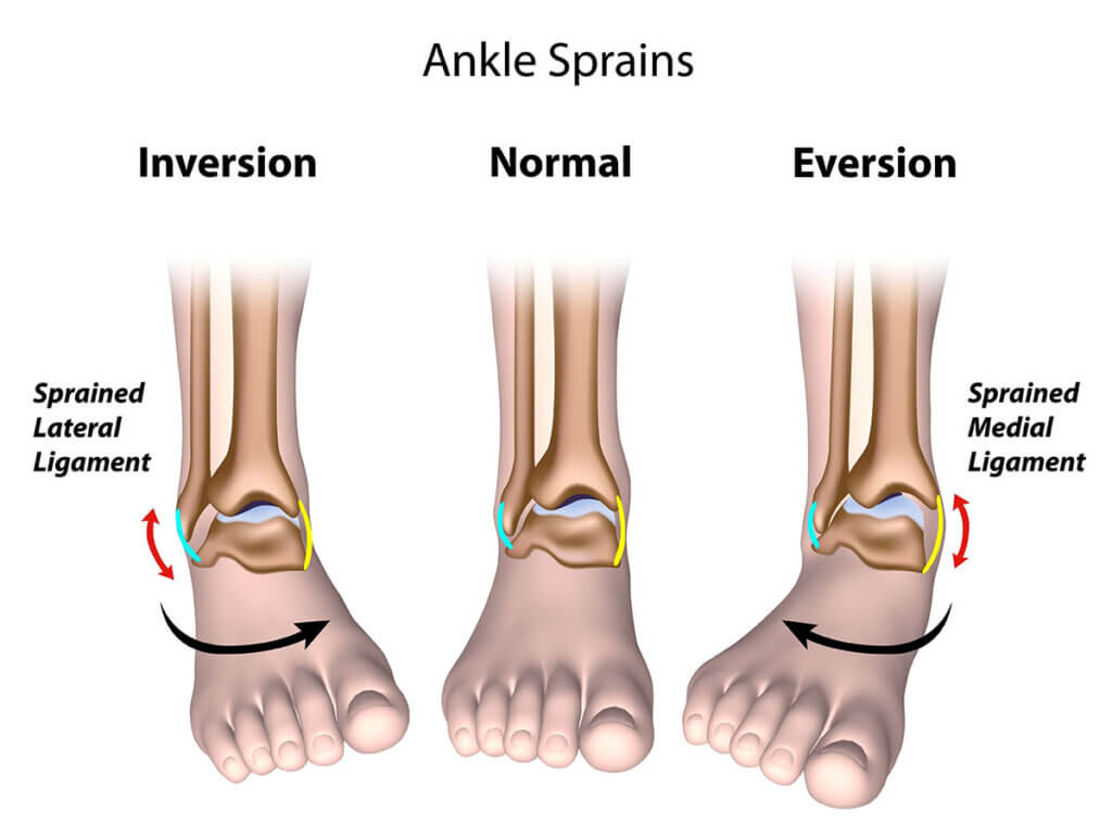 ankle sprain