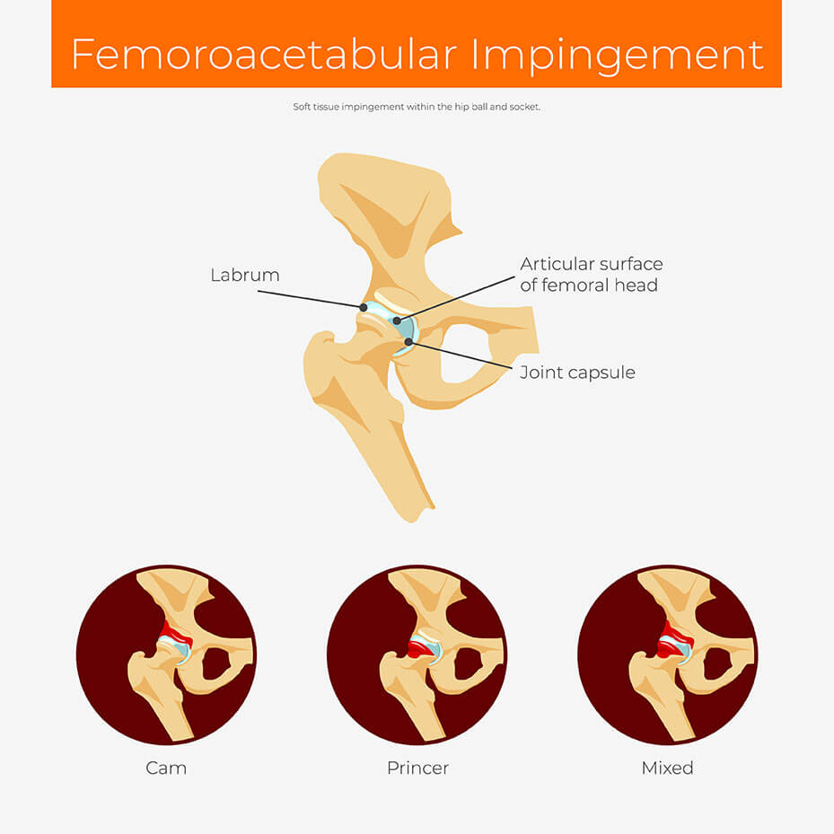 hip impingement