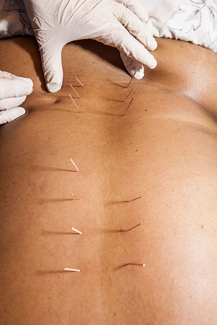 dry needling