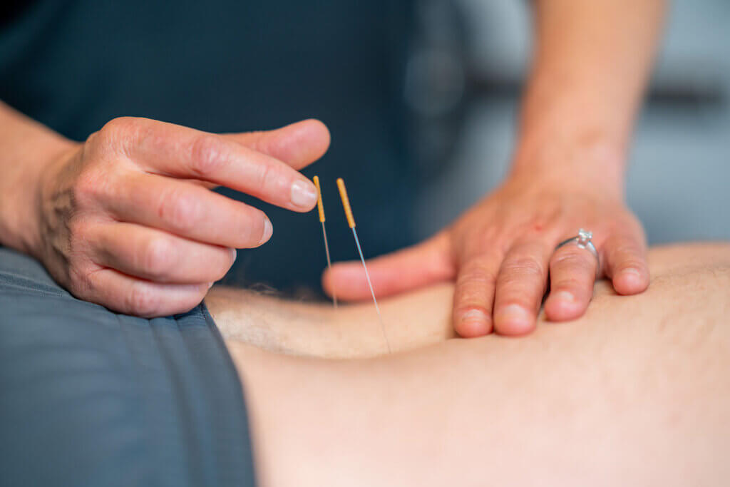 dry needling
