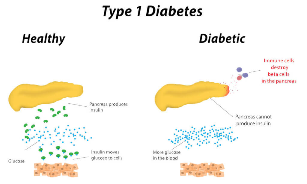 diabetes