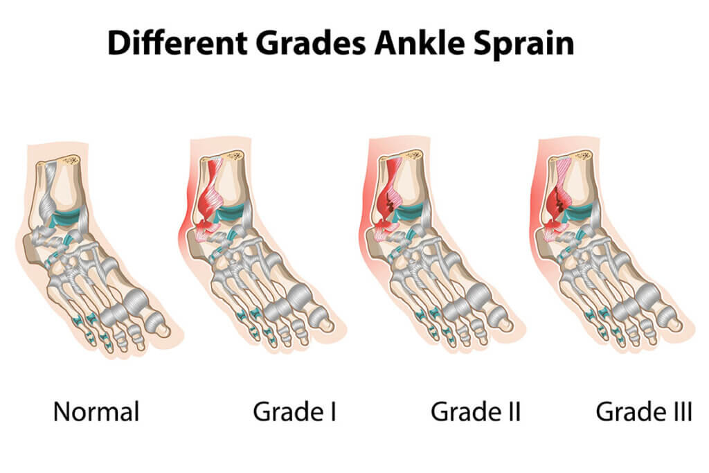 ankle sprain