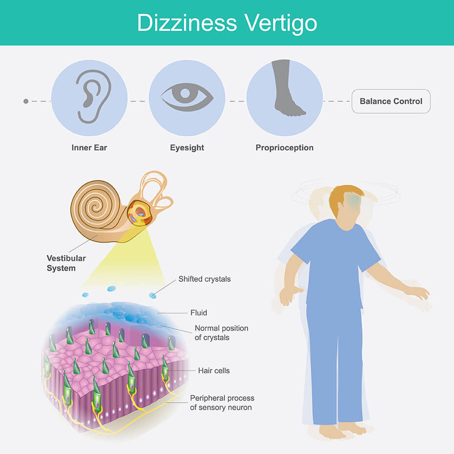 vertigo dizziness bppv